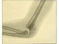 Zobacz kolekcję Narzędzia ortopedyczne